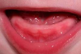 Когда у ребенка начинают резаться первые зубы и в какой последовательности они появляются: график прорезывания
