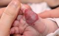 Гемангиома у новорожденных: причины возникновения и лечение Гемангиома у новорожденных детей и лечение