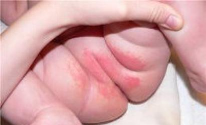 Детский дерматит: почему возникает, как выглядит, чем опасен и как лечить?