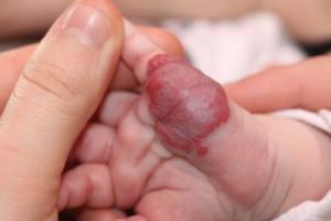 Гемангиома у новорожденных: причины возникновения и лечение Гемангиома у новорожденных детей и лечение